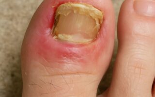 Ayak Tırnağı İçin Hangi Doktora Gidilir?