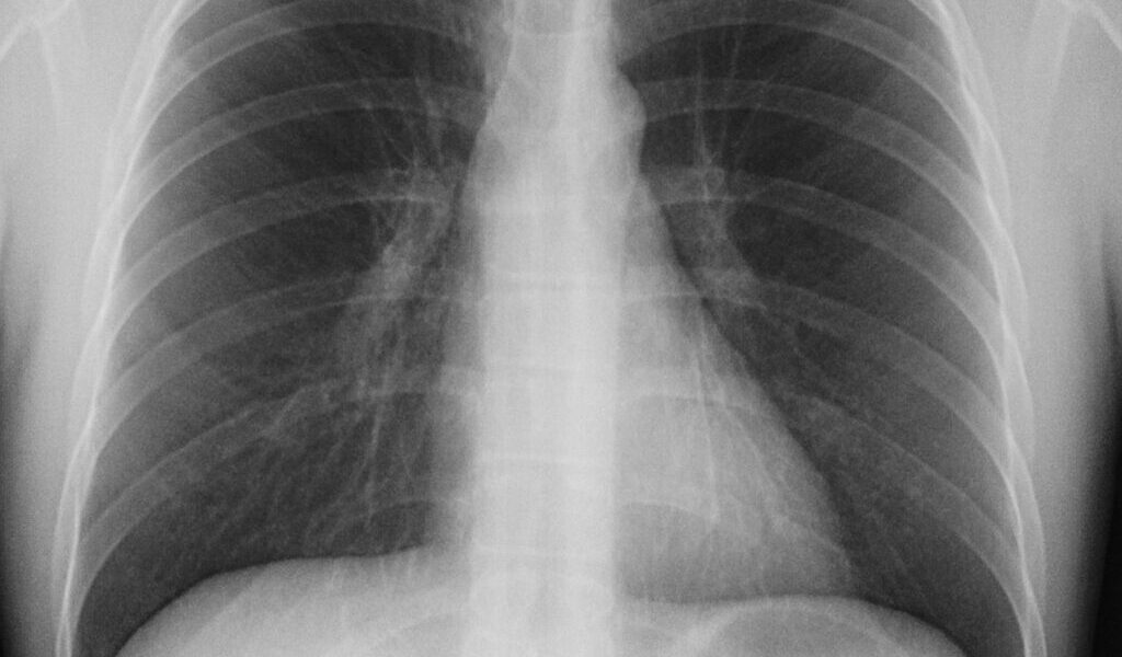 Akciğer Ağrısı İçin Hangi Doktora Gidilir?