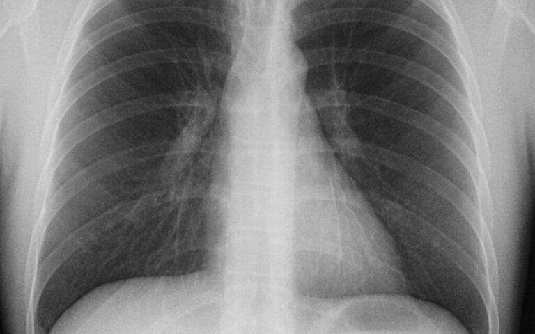 Akciğer Ağrısı İçin Hangi Doktora Gidilir?